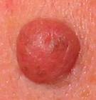 ¿Cómo quitar lunares en la piel?