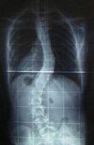 Ejercicios para la escoliosis