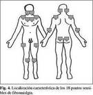Puntos sensibles en la fibromialgia